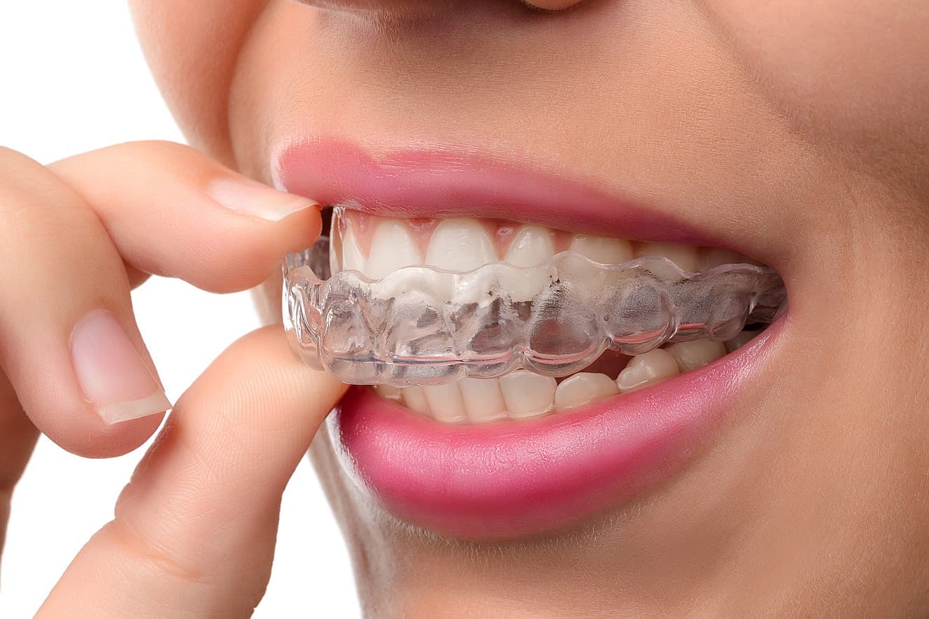 Zahnschienen und Zahnhygiene: Tipps für eine saubere Anwendung