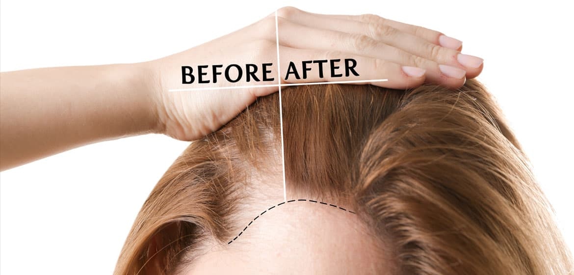 Haartransplantation in der türkei bei Narbenbildung: Heilung und Wiederherstellung